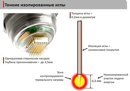 micro needle lifting